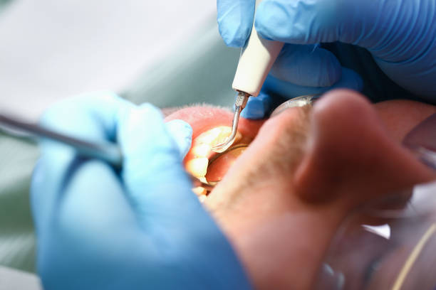 Best Knocked-Out Tooth (Avulsed Tooth) Treatment in Zeigler, IL