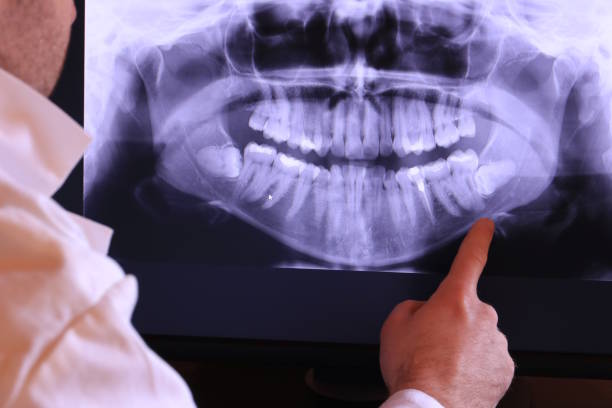 Best Emergency Wisdom Tooth Extraction in Zeigler, IL